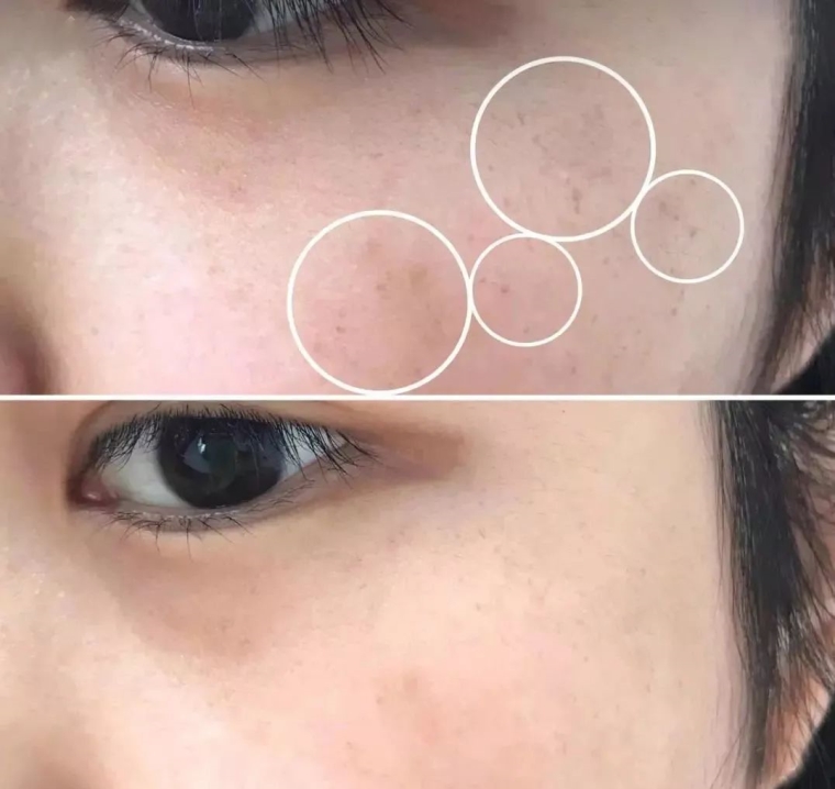 小编今天说说北京老年人能做激光祛斑吗 小编今天说说北京老年人能做激光祛斑吗