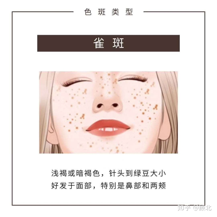 细致说说杭州激光祛斑效果怎么样 细致说说杭州激光祛斑效果怎么样