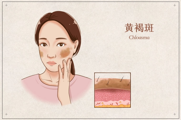 细致说说杭州激光祛斑效果怎么样 细致说说杭州激光祛斑效果怎么样