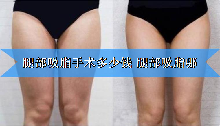 高手详解腿部吸脂手术多少钱 腿部吸脂哪里好 高手详解腿部吸脂手术多少钱 腿部吸脂哪里好