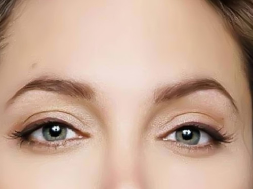 无痕开眼角如何选择医院 无痕开眼角如何选择医院