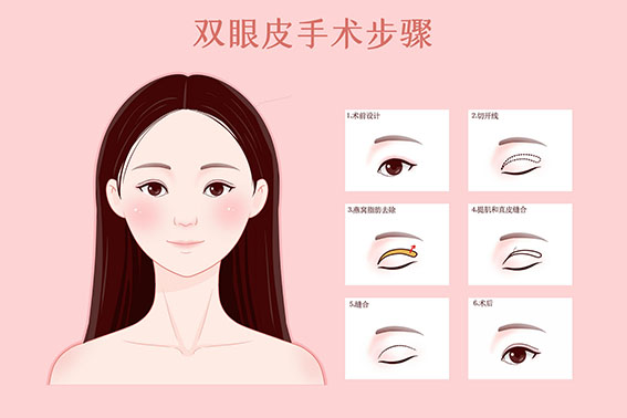 1658367128294338.jpg 摄图网_401808976_banner_双眼皮手术步骤医疗插画(非企业商用).jpg