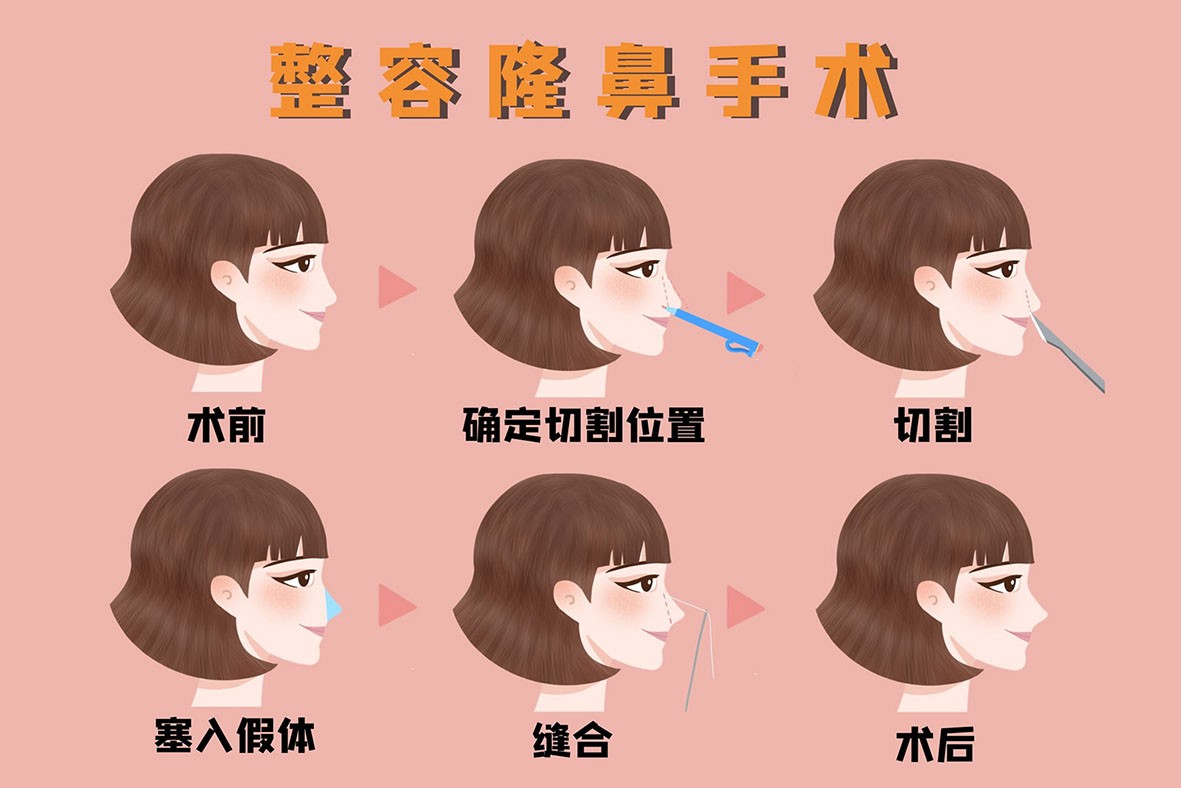 1658539616132999.jpg 摄图网_401950005_banner_医美整容隆鼻手术流程图(非企业商用).jpg