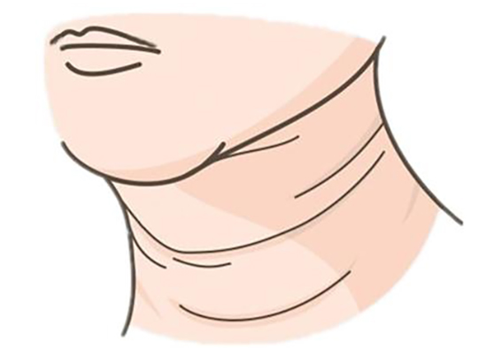 1678930428352148.jpeg 嗨体去颈纹效果怎么样?嗨体去颈纹效果可以维持多久?