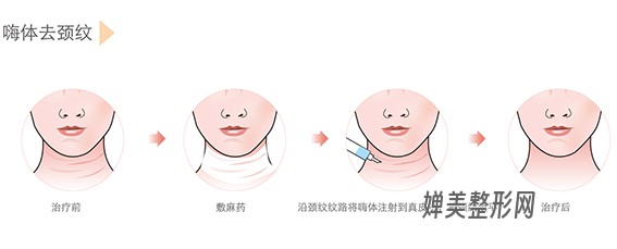 1678930438200405.jpg 嗨体去颈纹效果怎么样?嗨体去颈纹效果可以维持多久?