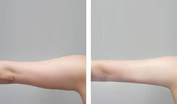 1679362029232794.jpeg 超声溶脂瘦手臂效果怎么样?超声溶脂瘦手臂要注意些什么?