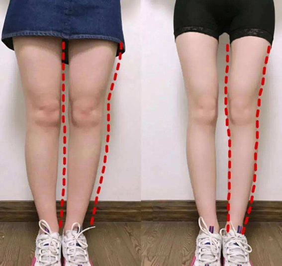 1679880786763844.jpeg 吸脂瘦腿效果怎么样?吸脂瘦腿有风险吗?