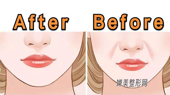 1679966928113707.jpg 玻尿酸去法令纹多久能恢复?玻尿酸去法令纹后怎么护理?