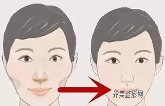 1680055001201703.jpg 颧骨整形的方法有哪些?颧骨整形手术要注意哪些问题?
