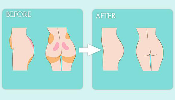 1680139832187333.jpeg 吸脂丰臀有哪些优点?吸脂丰臀后要注意哪些问题?