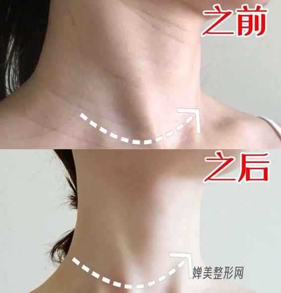 1680139990845452.jpg 去颈纹手术效果好不好?去颈纹后怎么护理?