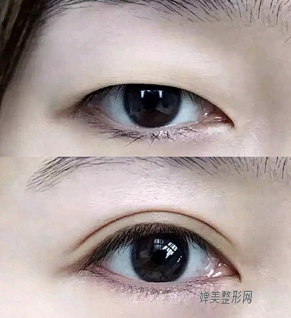 1680227298199357.jpg 双眼皮吸脂效果好不好?双眼皮吸脂有风险吗?
