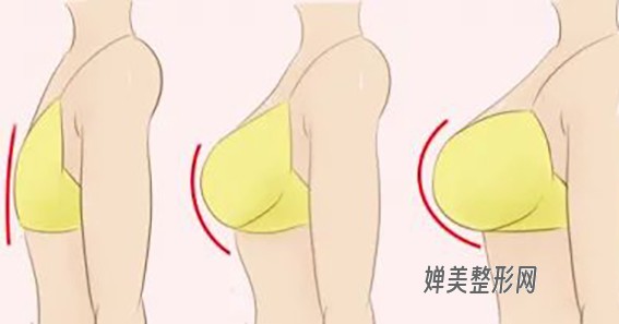 1680227455151485.jpg 假体隆胸材料有什么区别?假体隆胸效果怎么样吗?