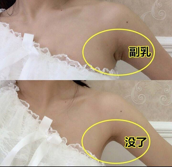 1680312099355426.jpeg 吸脂去副乳效果好不好?吸脂去副乳要注意哪些问题?