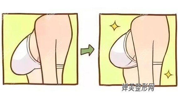 1680485191783631.jpg 隆胸的方法有哪些?假体隆胸效果怎么样?