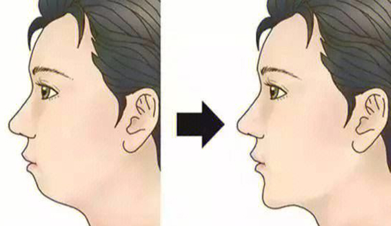 1680572057144368.jpeg 玻尿酸垫下巴效果好不好?玻尿酸垫下巴有哪些优点?