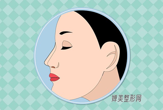 1680744015571153.jpg 隆鼻的方法有哪些?隆鼻后多久能恢复?