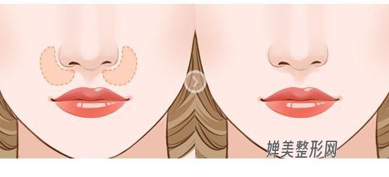 1680744749323180.jpg 玻尿酸填鼻唇沟要多少用量?玻尿酸填鼻唇沟后怎么护理?