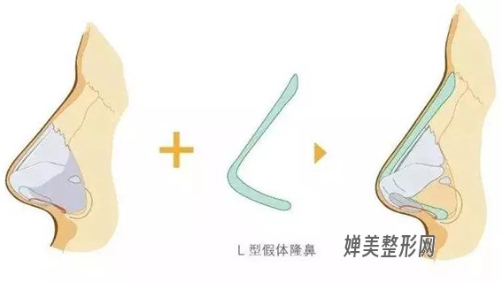 1680830774161200.jpg 假体隆鼻效果好不好?隆鼻假体取出对身体有影响吗?