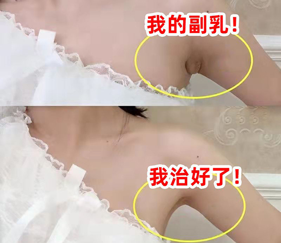 1680831048280601.jpeg 去副乳的方法有哪些?去副乳手术有哪些优点?
