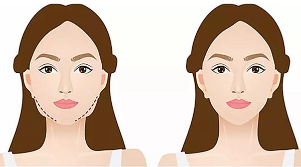 1681090181188215.jpeg 瘦脸针瘦脸效果好不好?注射瘦脸针要注意哪些问题?