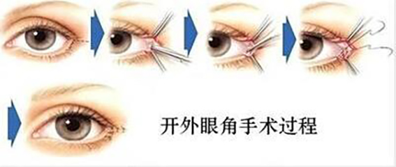 1681090322871885.jpeg 开眼角手术效果怎么样?开眼角后要注意些什么?