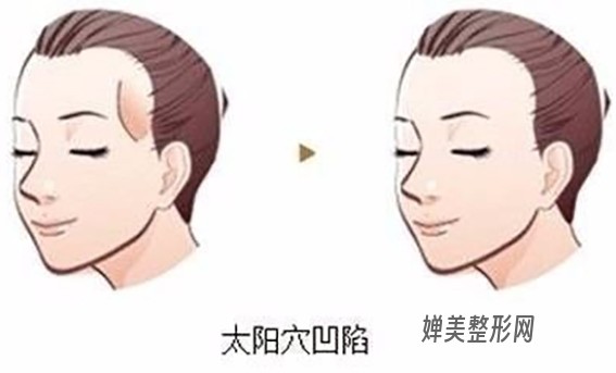 1681176192171459.jpg 丰太阳穴的方法有哪些?注射丰太阳穴效果好不好?