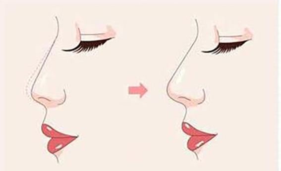 1681176345721936.jpeg 韩式综合隆鼻要多少费用?韩式综合隆鼻效果怎么样?