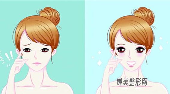 1681176485175393.jpg 双眼皮手术要多少费用?双眼皮手术有哪些注意事项?