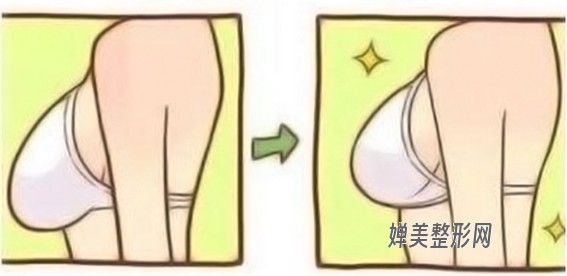 1681176642118756.jpg 胸下垂矫正手术效果怎么样?胸下垂矫正手术后怎么护理?