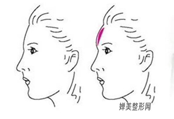 1681262384177773.jpg 玻尿酸丰额头效果好不好?玻尿酸丰额头有哪些注意事项?