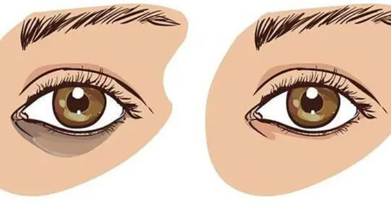 1681262662928361.jpeg 去眼袋的方法有哪些?外切去眼袋效果好不好?