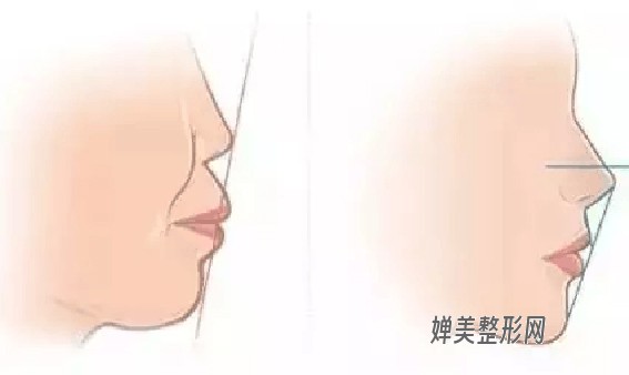 1681262829118355.jpg 玻尿酸隆鼻效果还不好?玻尿酸隆鼻有哪些注意事项?