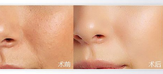 1681262959151545.jpeg 彩光嫩肤效果怎么样?彩光嫩肤后怎么护理?