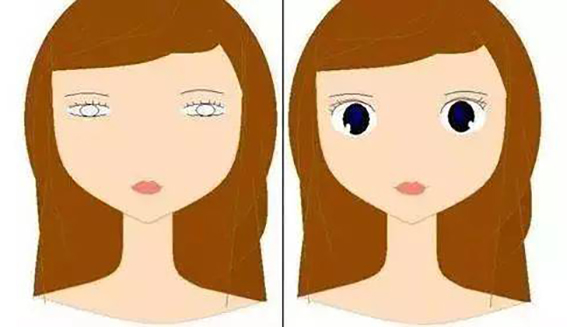 1681348996172710.jpeg 双眼皮修复手术效果明显吗?双眼皮修复手术多久才能做?