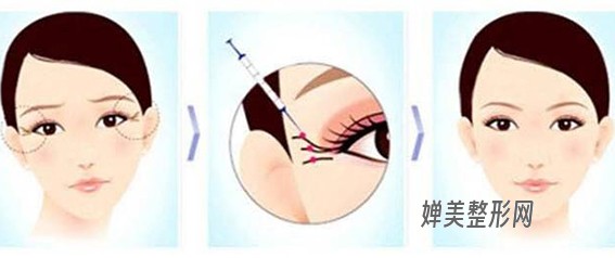 1681349112177593.jpg 玻尿酸去鱼尾纹效果好不好?玻尿酸去鱼尾纹要注意些什么?