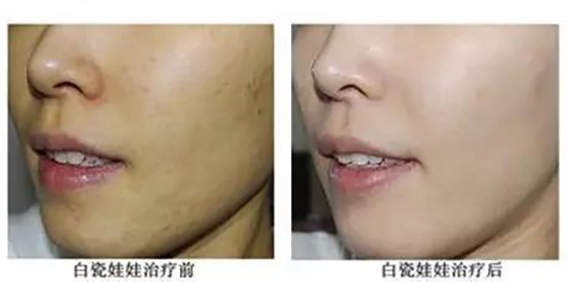 1681349238360721.jpeg 白瓷娃娃美肤后怎么护理?做完白瓷娃娃能用化妆品吗?