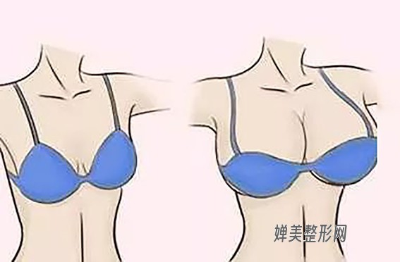 1681349387672775.jpg 假体隆胸有风险吗?假体隆胸失败能做修复手术吗?