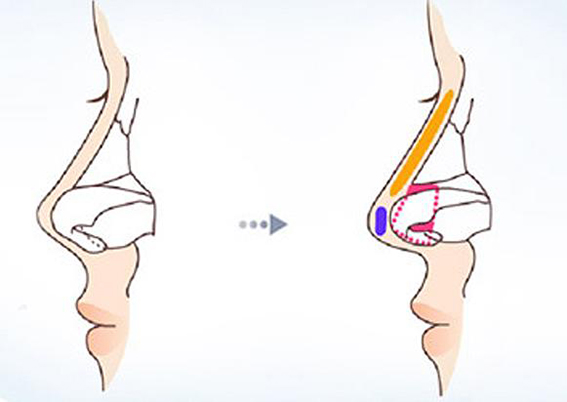 1681435311927058.jpeg 延长鼻小柱的方法有哪些?鼻小柱延长效果好不好?