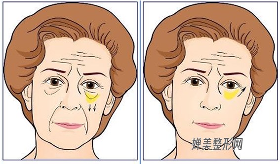 1681435482408583.jpg 去眼袋的方法有哪些?内切去眼袋和外切去眼袋有什么区别?