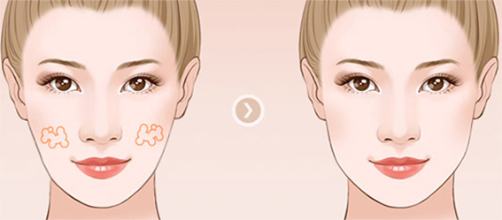 1681435662279402.jpeg 自体脂肪丰苹果肌有哪些优点?自体脂肪丰苹果肌效果好不好?