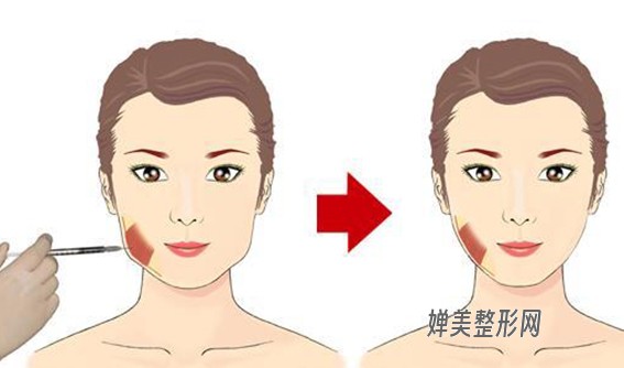 1681435783475519.jpg 瘦脸针瘦脸效果怎么样?注射瘦脸针要注意哪些问题?