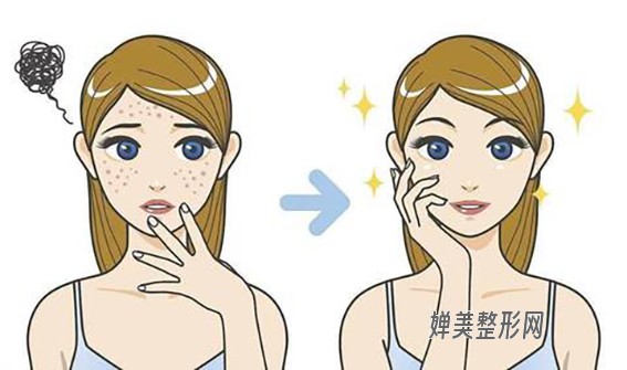 1681521727194211.jpg 光子嫩肤有哪些功效?光子嫩肤去痘印效果好不好?