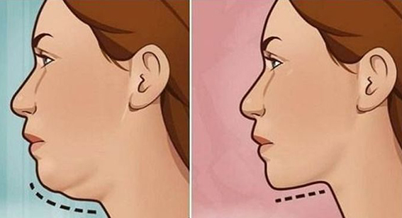 1681521851112531.jpeg 吸脂瘦双下巴有副作用吗?吸脂瘦双下巴要多少费用?