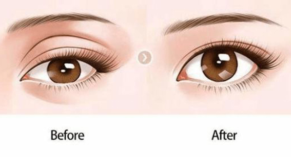 1681522097155924.jpeg 双眼皮手术效果好不好?双眼皮手术恢复期有多久?