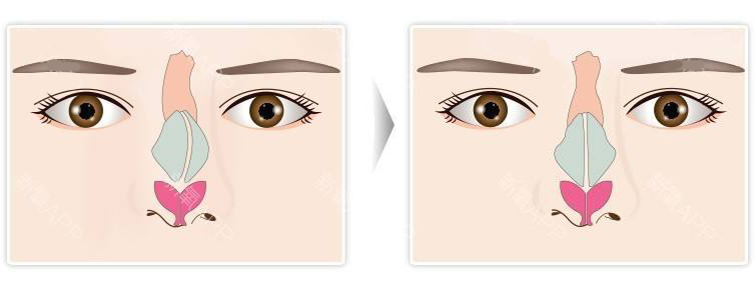 1681522239418603.jpeg 鼻骨矫正手术有副作用吗?鼻骨矫正后怎么护理?