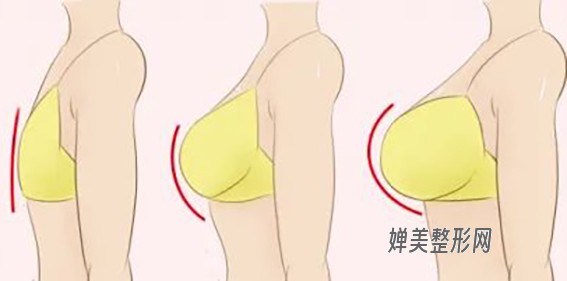 1681694530388311.jpg 玻尿酸注射隆胸效果好不好?玻尿酸注射隆胸有哪些注意事项?