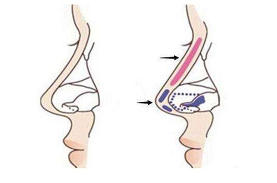 1681694674211849.jpeg 隆鼻手术要多少钱?隆鼻手术恢复期有多久?