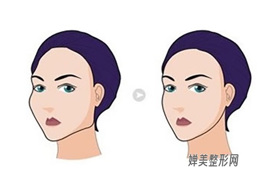 1681780814210742.jpg 磨骨手术效果怎么样?磨骨手术有风险吗?