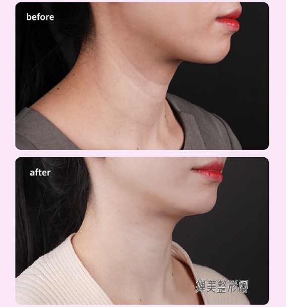 1681781061251417.jpg 玻尿酸去颈纹效果好不好?玻尿酸去颈纹要注意些什么?